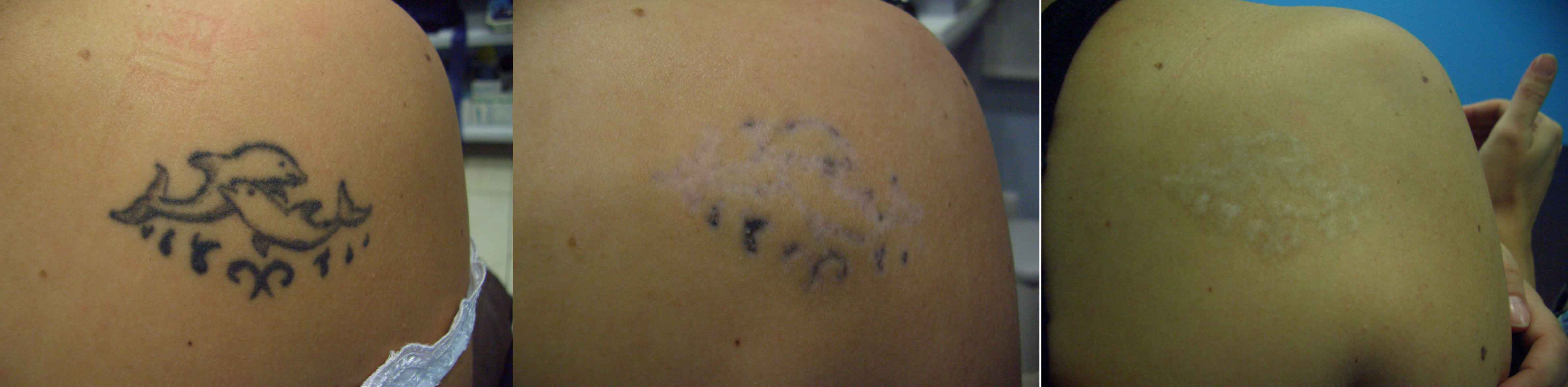 Eliminación de un tatuaje, tras 5 y 9 sesiones